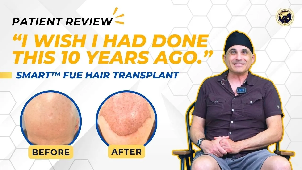 Life-Changing SMART™ FUE Hair Transplant Review l Testimonial