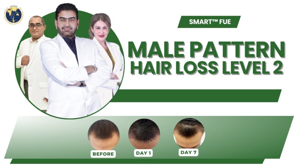 male-pattern-hair-loss-level-2-hair-transplant-malaysia