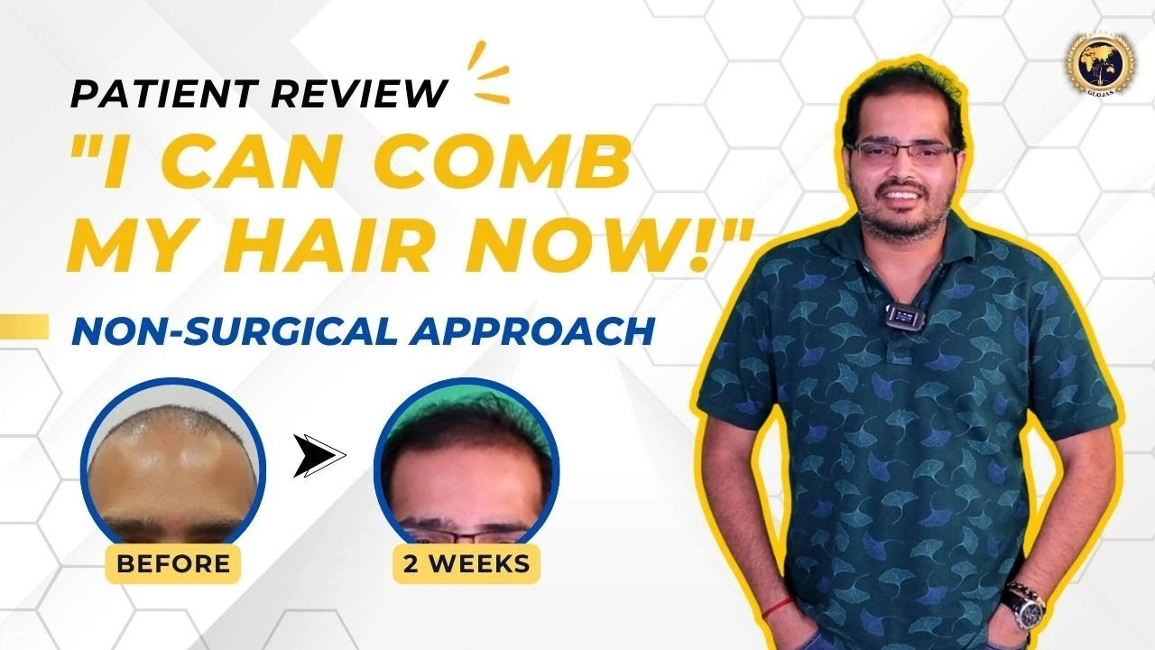 2 Weeks Post Non-Surgical Of Hair Loss Treatment