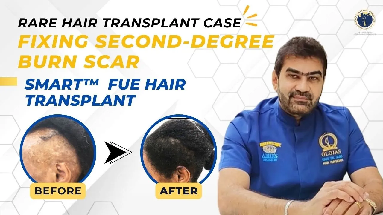 Hair Transplant in Malaysia | Best Results & Cost of Hair Transplant in Malaysia | Hair Regrowth After Burn Injury: Hair Transplant Special Case
