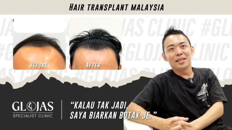 tanam-rambut-transformasi-selepas-1-tahun