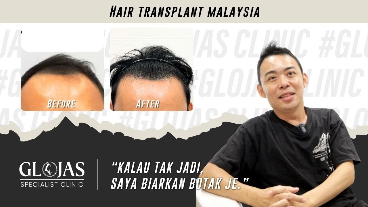 Hair Transplant Malaysia | Tanam Rambut: Transformasi Selepas 1 Tahun