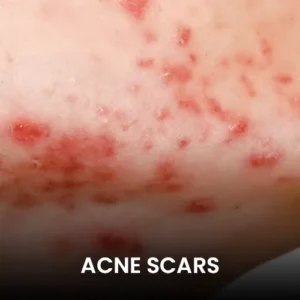 acne-scars-pico-laser