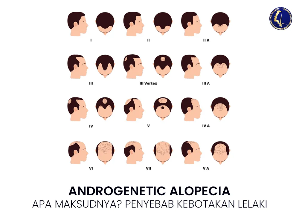 androgenetic-alopecia-1