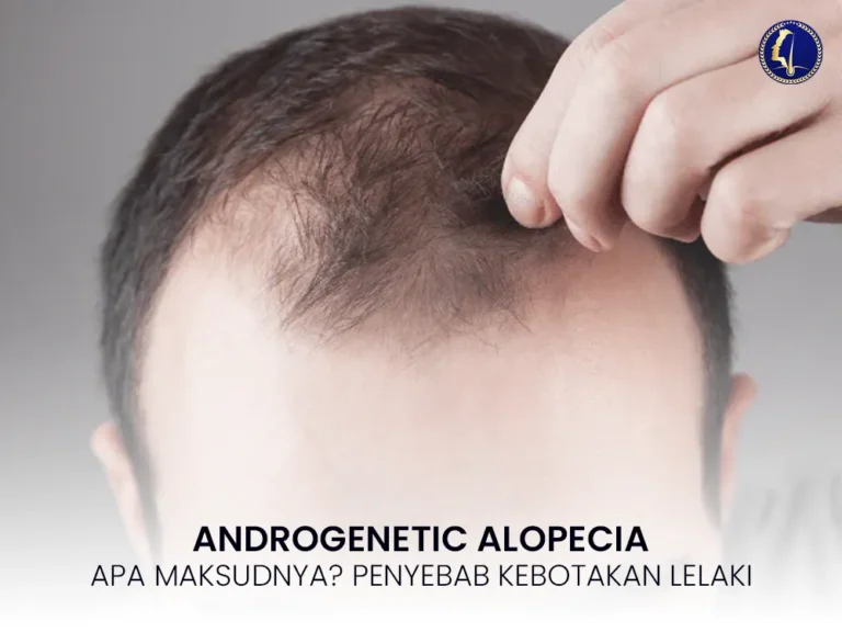 androgenetic-alopecia-2