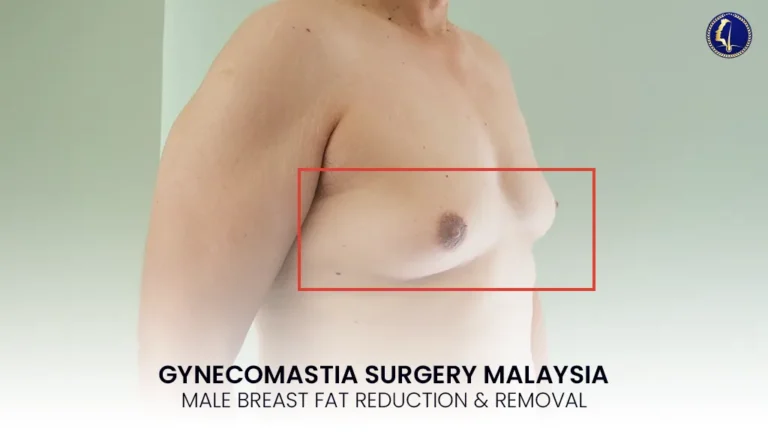 gynecomastia-surgery-malaysia-male-breast-reduction