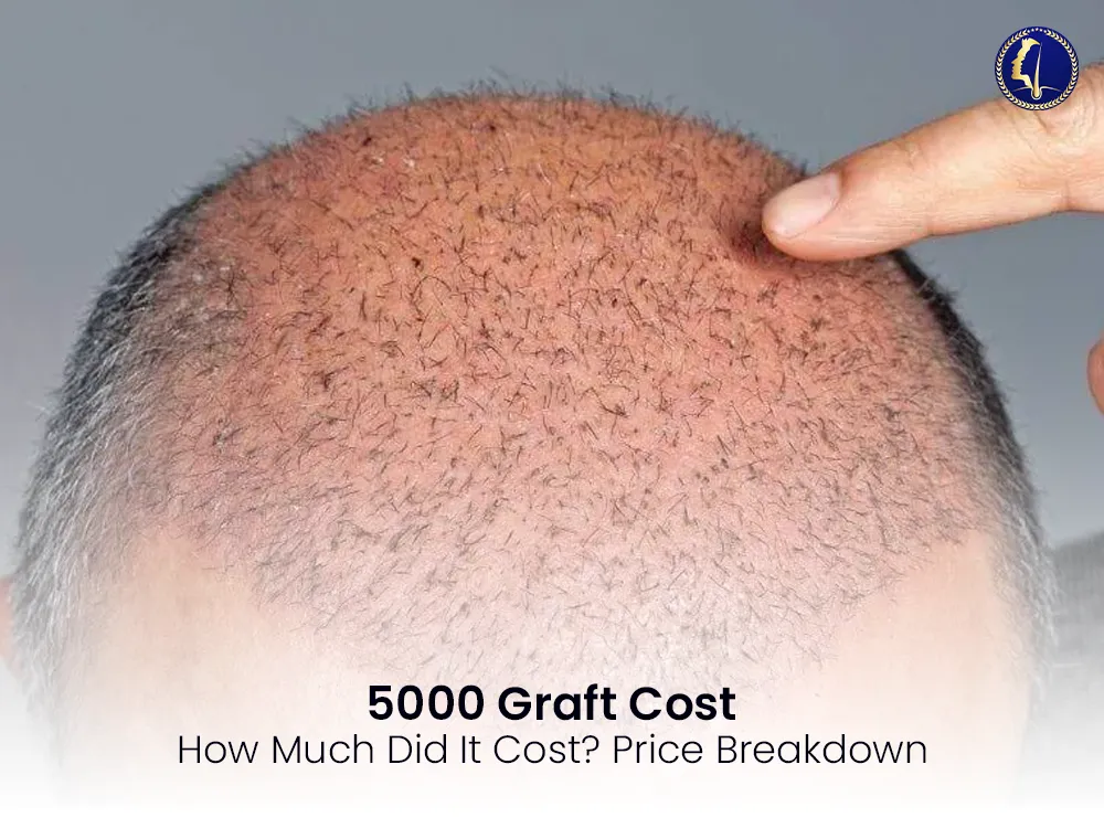 hair-graft-5000-cost-malaysia