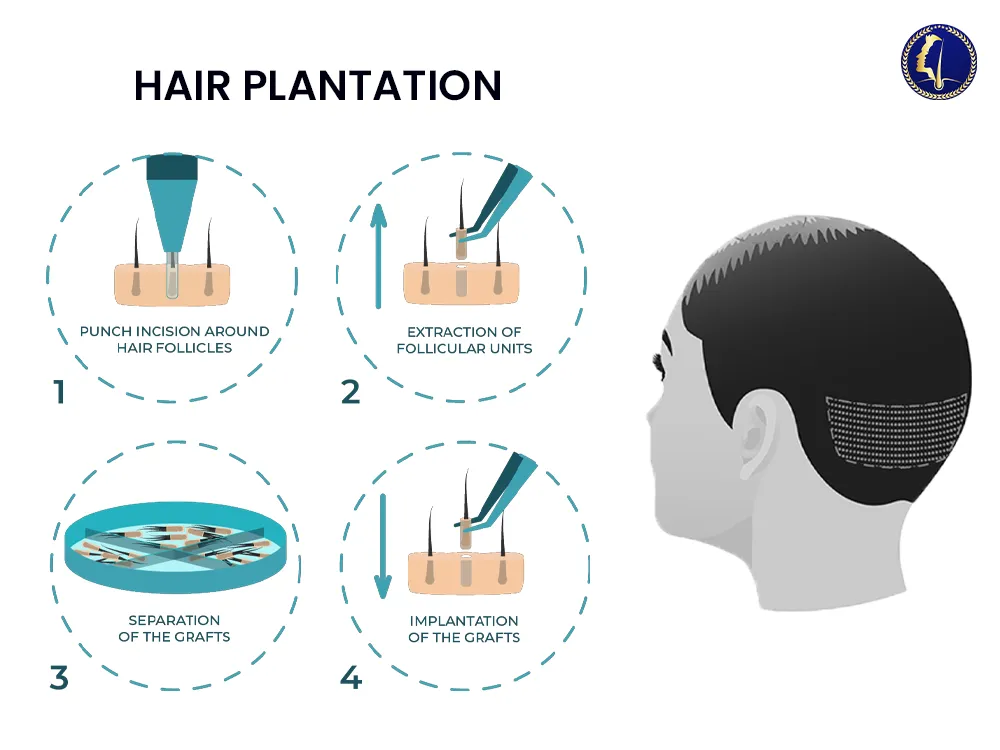 hair-plantation-hair-transplant-malaysia-hairline