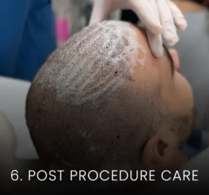 hair-transplant-malaysia-post-procedure-care