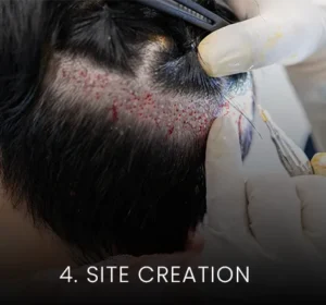 hair transplant malaysia site creation