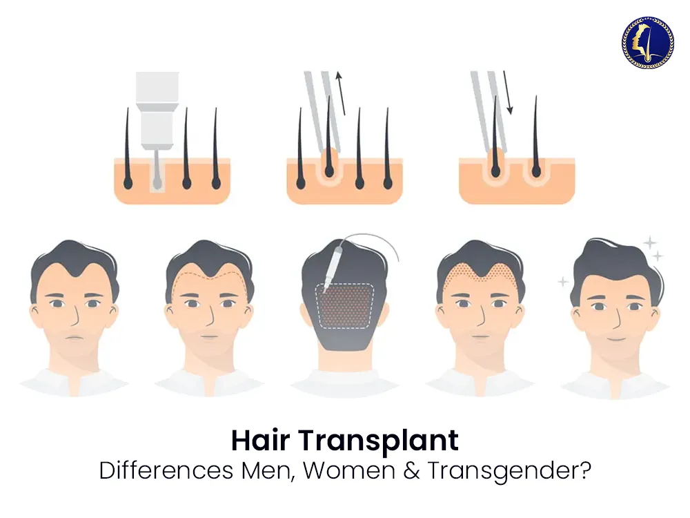 hair-transplant-men-women-transgender-1