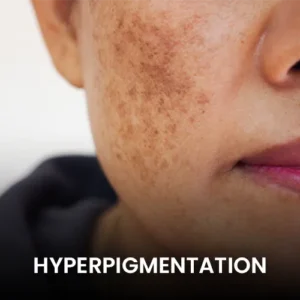 hyperpigmentation-pico-laser