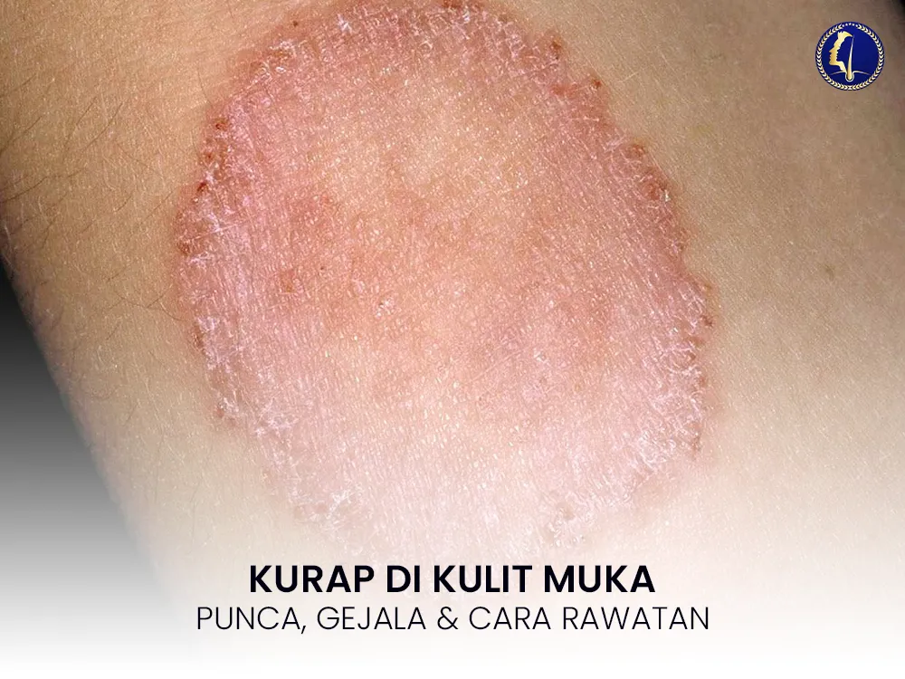 kurap-di-muka-cara-rawat