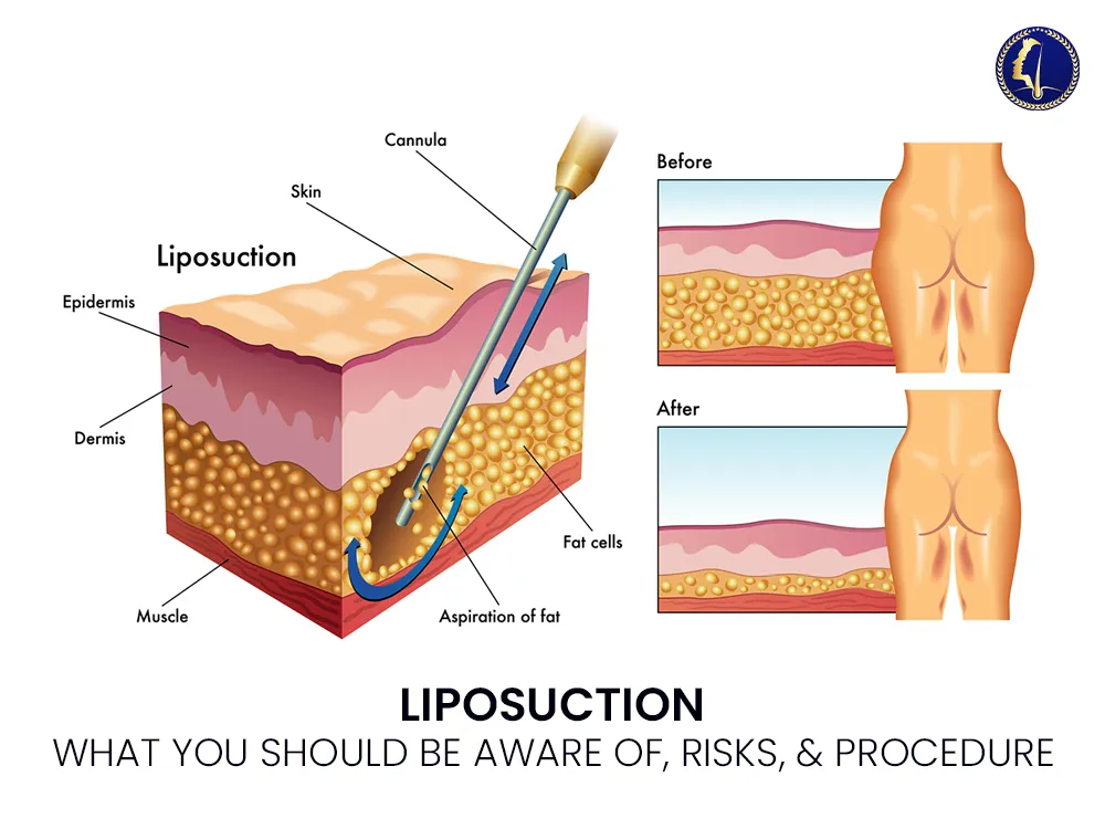 liposuction-surgery-risk-procedure-1