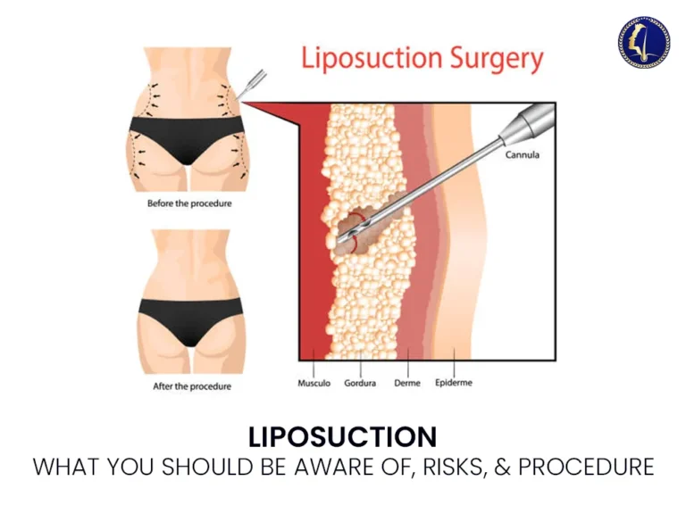 liposuction-surgery-risk-procedure