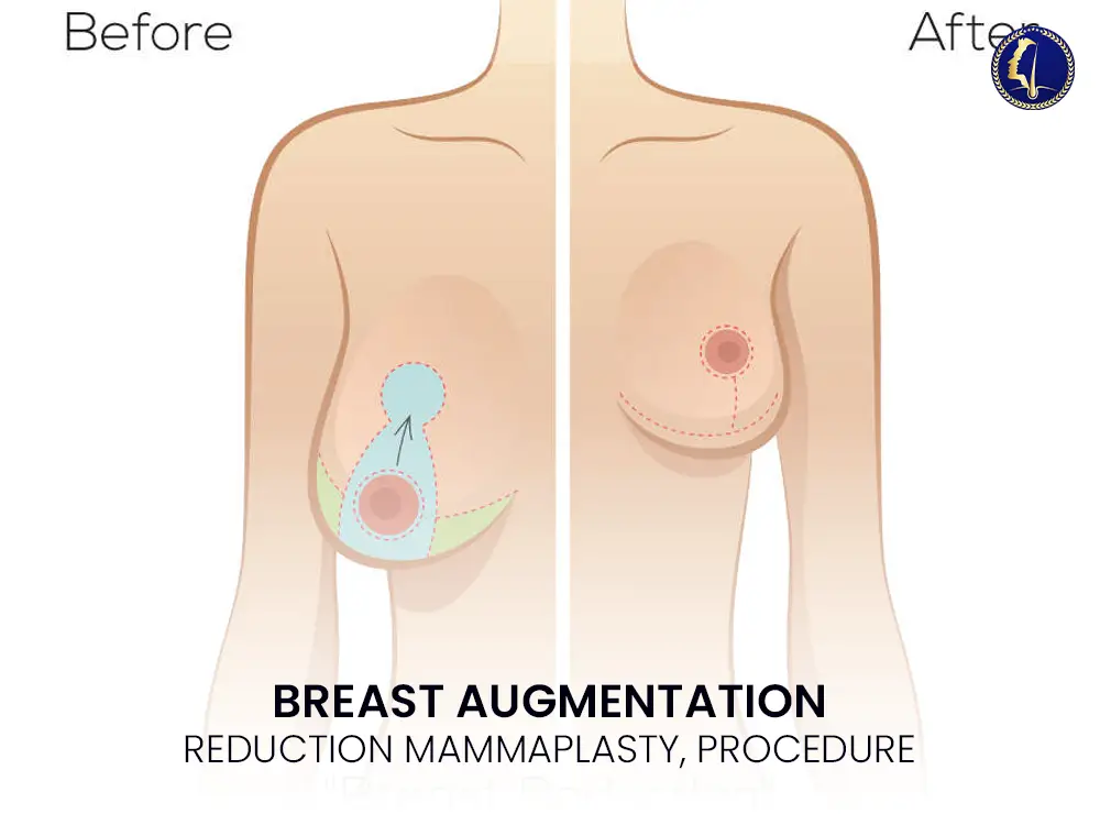 breast-reduction-mammaplasty-surgery-malaysia