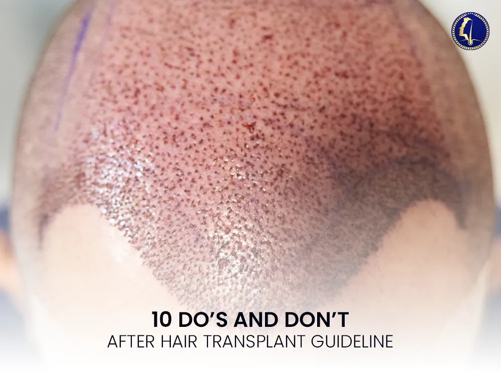 hair-transplant-dos-dont-1