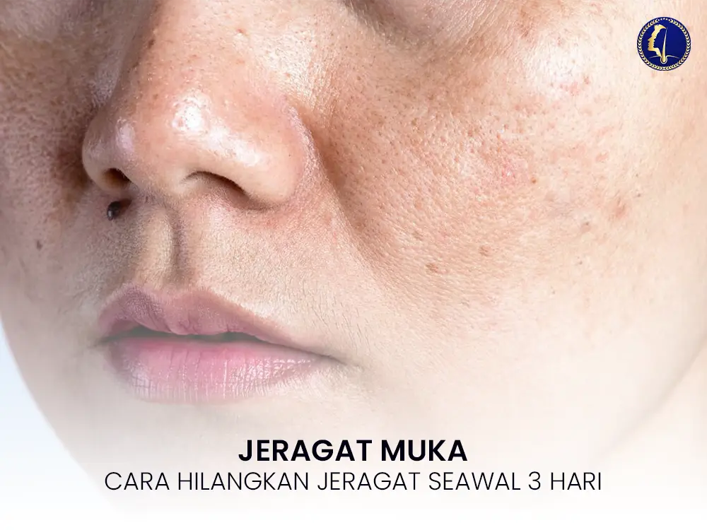 jeragat-muka-cara-hilangkan