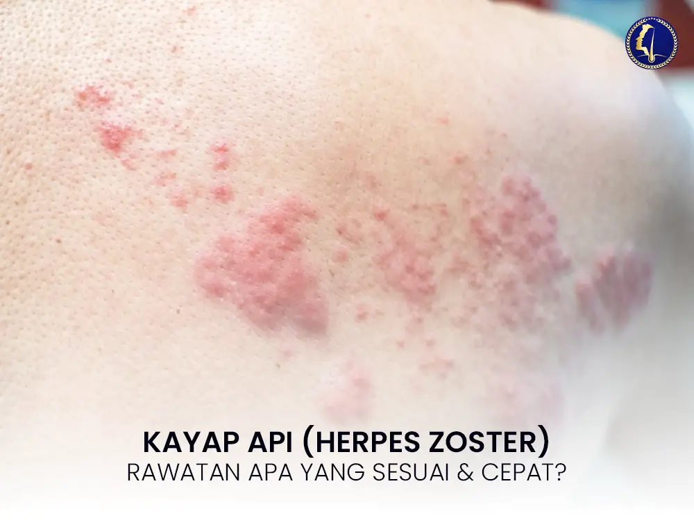 kayap-api-herpes-zoster-rawatan-cepat-cara