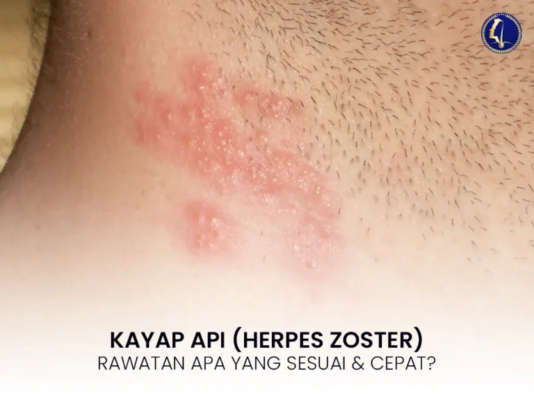 kayap-api-herpes-zoster-cara-rawatan-cepat