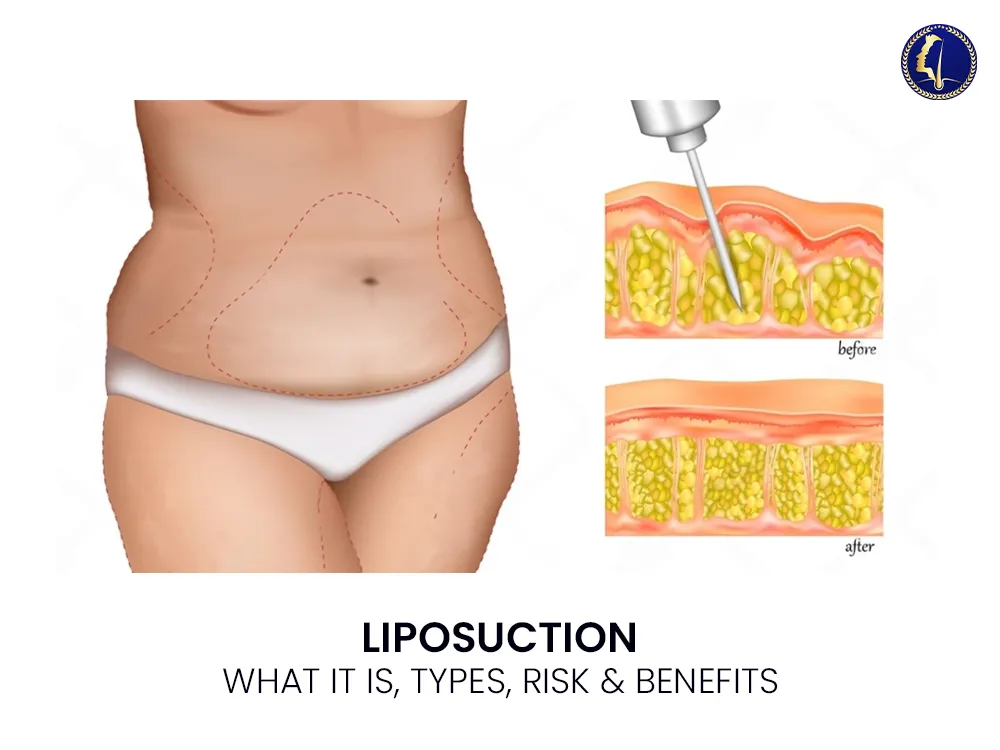 liposuction-1