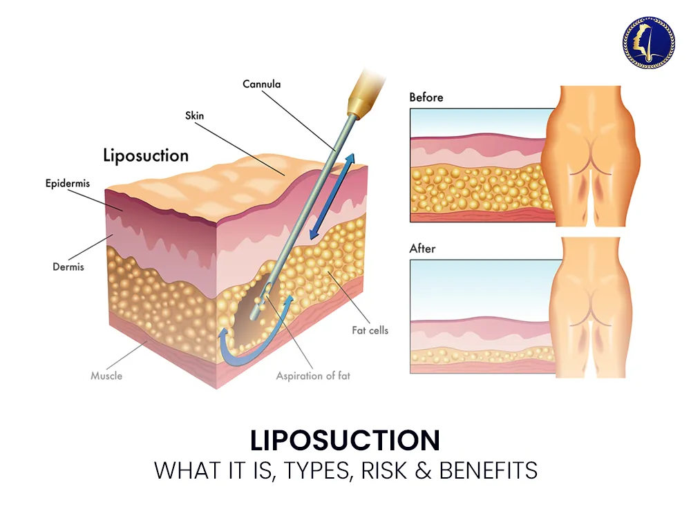 liposuction