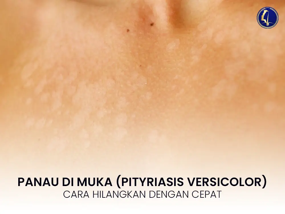 panau-di-muka-pityriasis-versicolor-cara-hilangkan