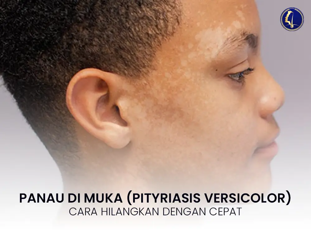 panau-di-muka-pityriasis-versicolor