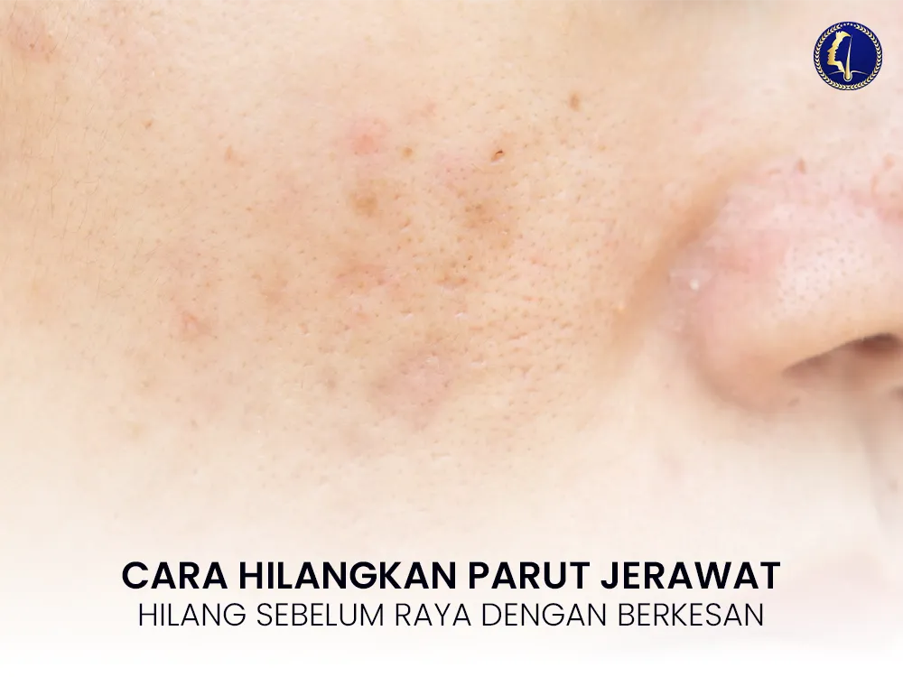 parut-jerawat-cara-hilangkan-1