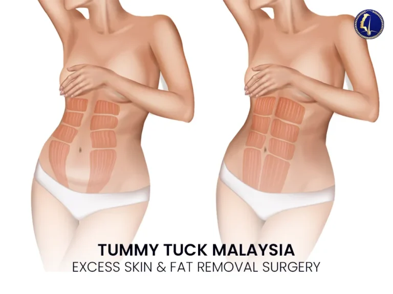 tummy-tuck-surgery-malaysia