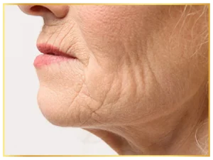 wrinkles-aesthetic-skin-treatments (3)