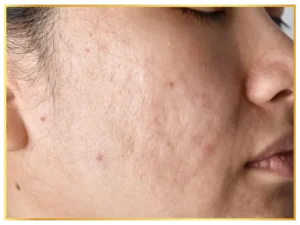 scars-aesthetic-skin-treatments (6)