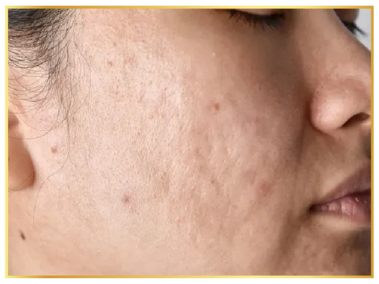scars-aesthetic-skin-treatments (6)