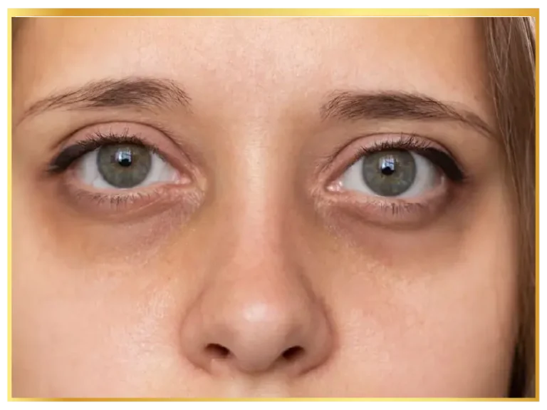 dark-eyes-circles