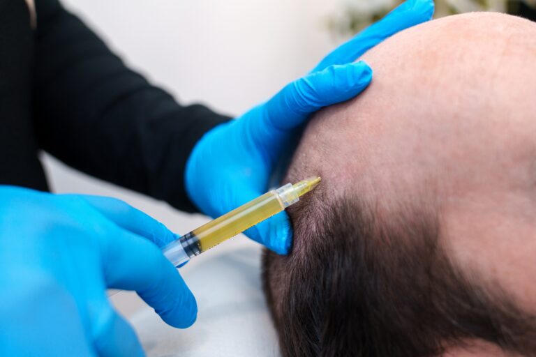 prp for hair loss hair loss treatment