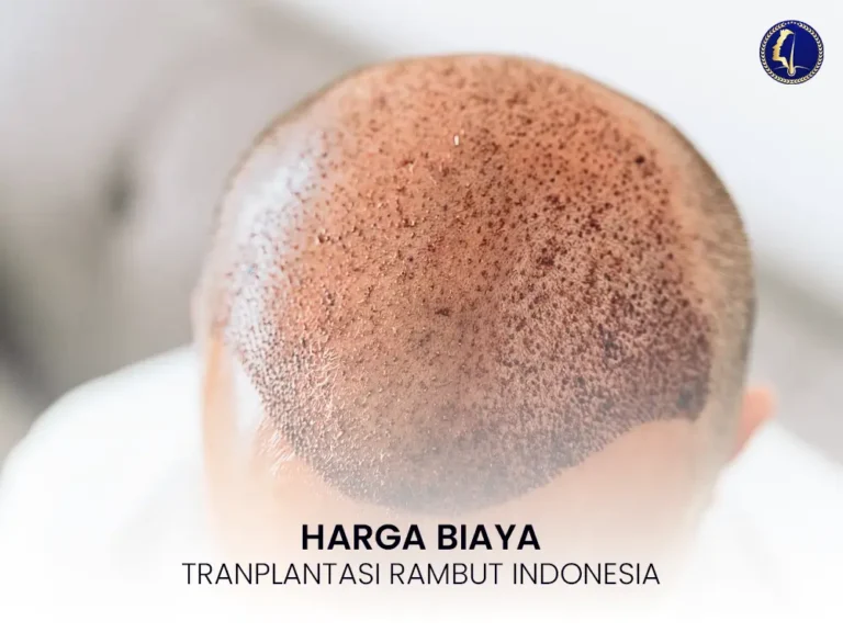 transplantasi-rambut-indonesia-biaya-harga-1