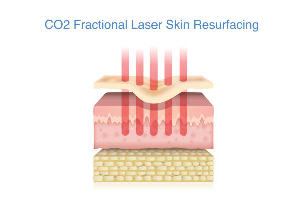 fractional-co2-laser