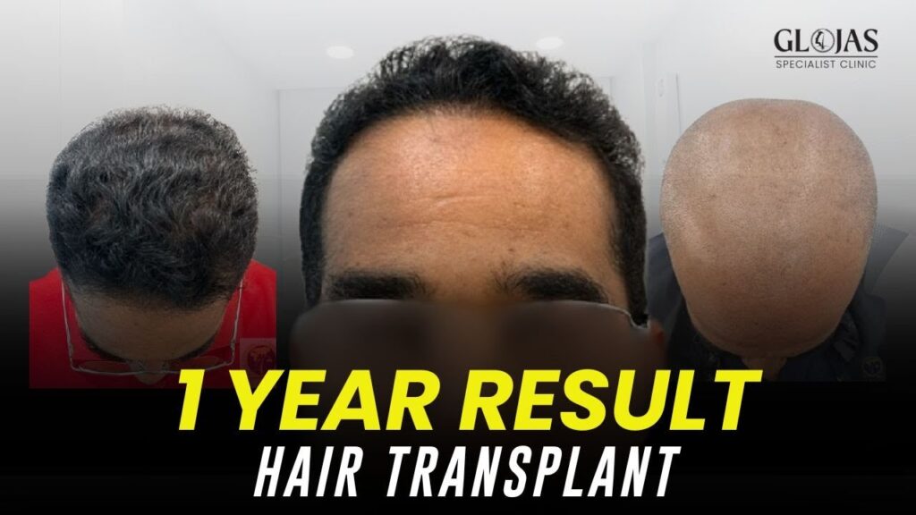 Hair Transplant Malaysia | Best Results & Cost of Hair Transplant in Malaysia 26 hair-transplant-1-year