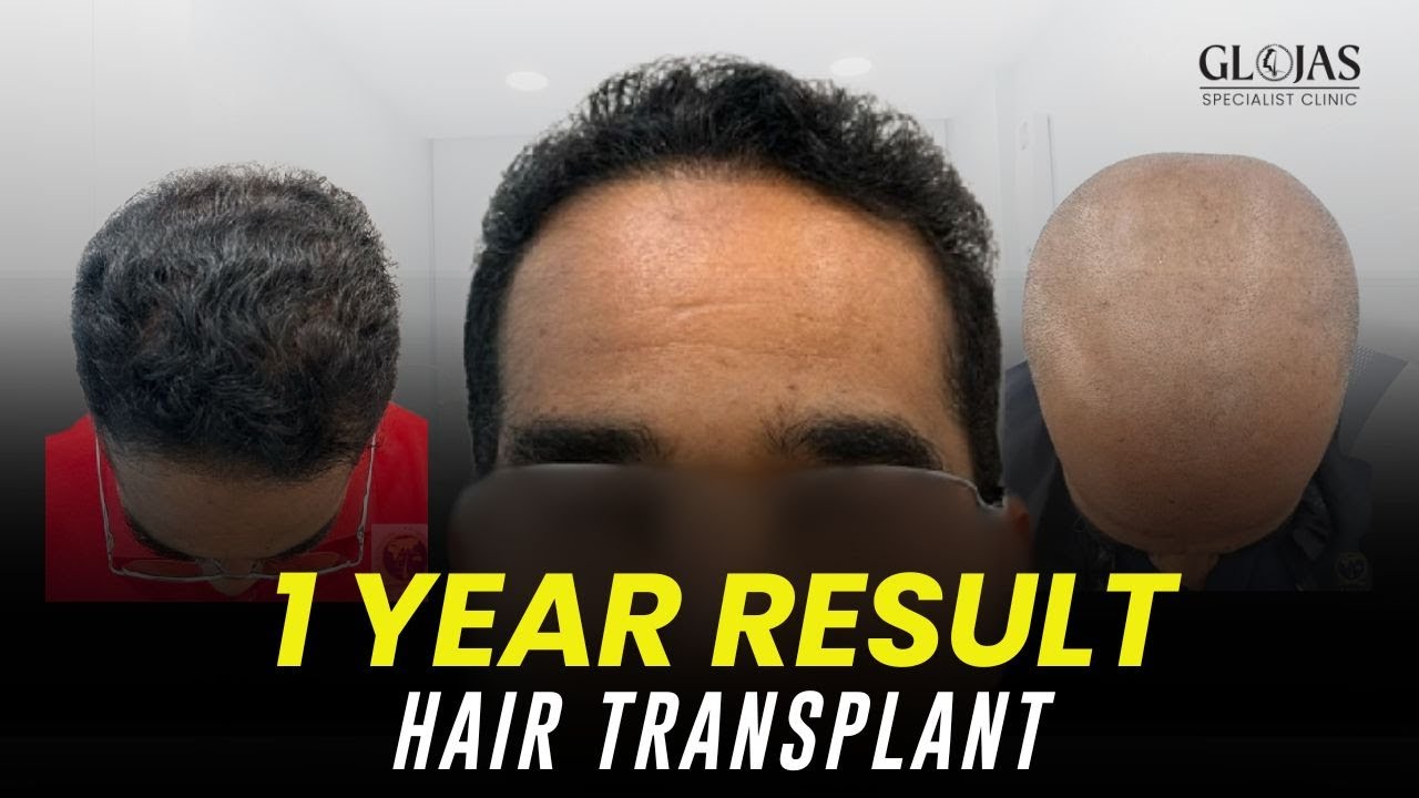 Hair Transplant Malaysia | Best Results & Cost of Hair Transplant in Malaysia