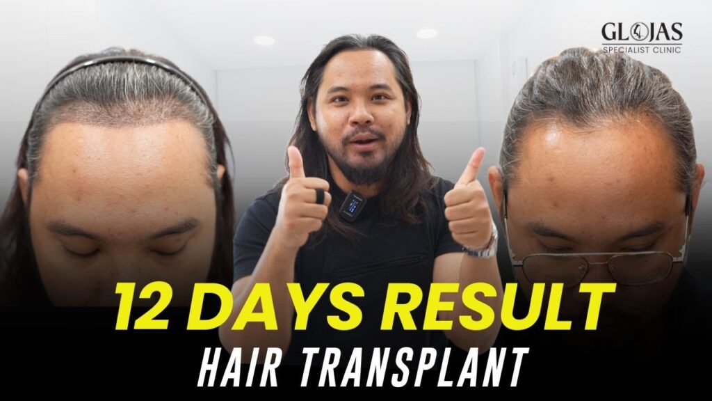 Tanam Rambut Malaysia | Pengalaman Tanam Rambut & Jambang | Hari Ke-12 Selepas Hair Transplant 11 hair-transplant-12-days