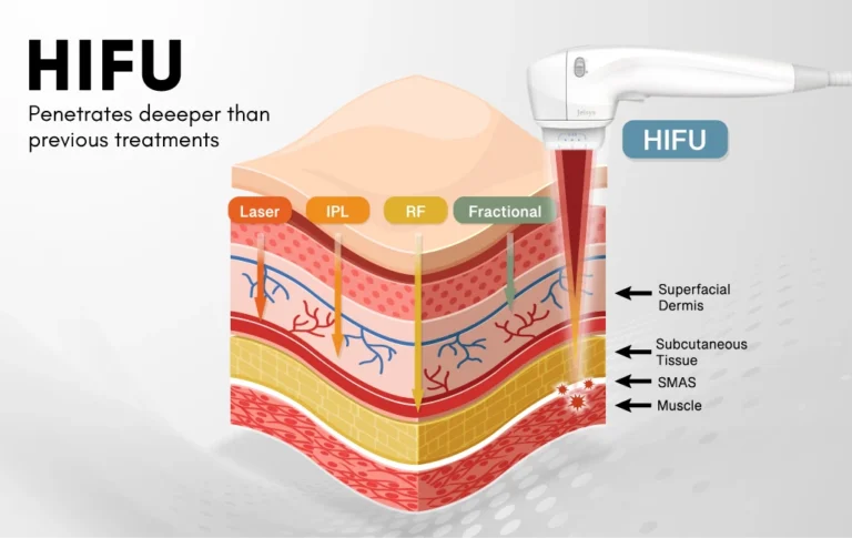 HIFU-Treatment-kuala-lumpur-malaysia-procedure