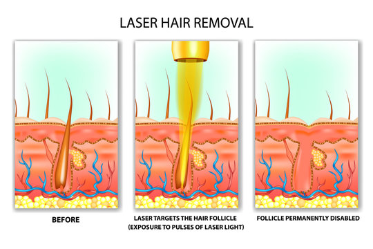 laser-hair-removal-malaysia