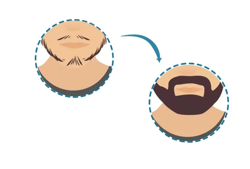 beard-transplant