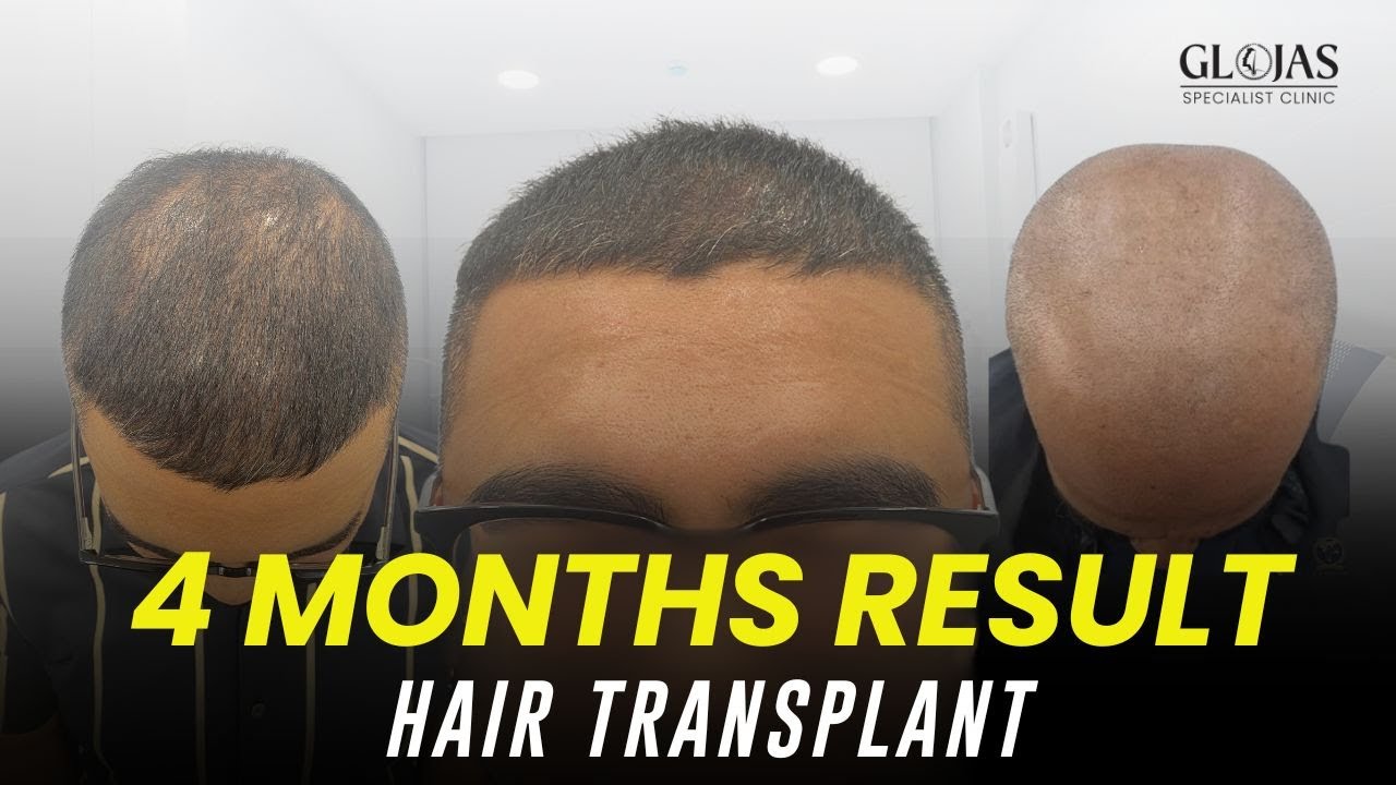 Hair Transplant Journey: M-Shaped Hair Loss Transformation & 4-Month Progress