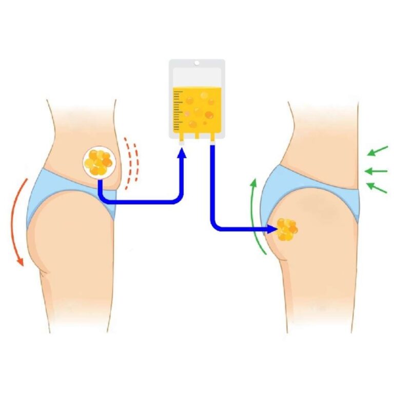 fat-transfer-surgery-malaysia