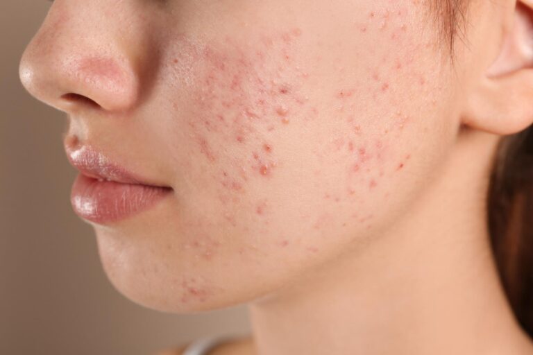 acne-treatment