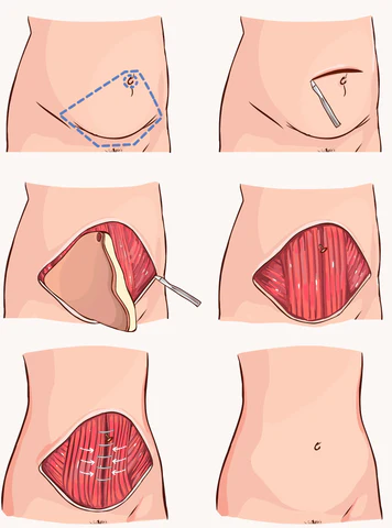 mini-tummy-tuck-malaysia-specialist-clinic-glojas-abdominoplasty