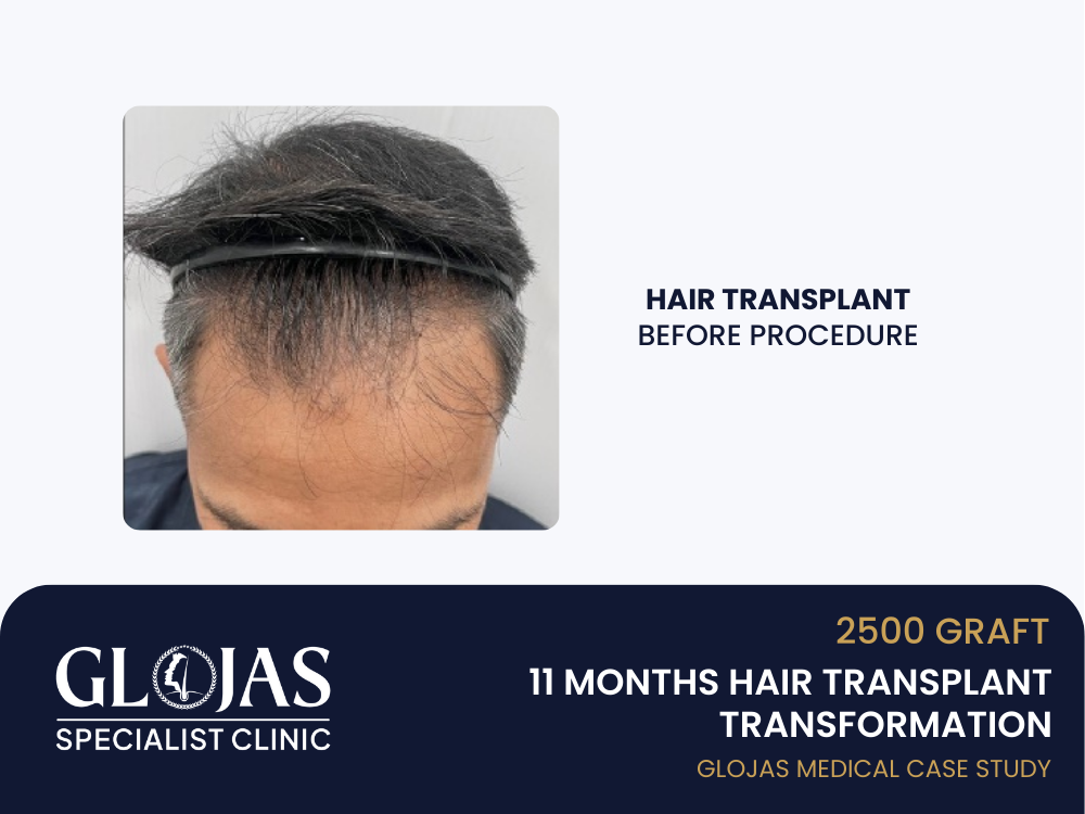 hair-transplant-before