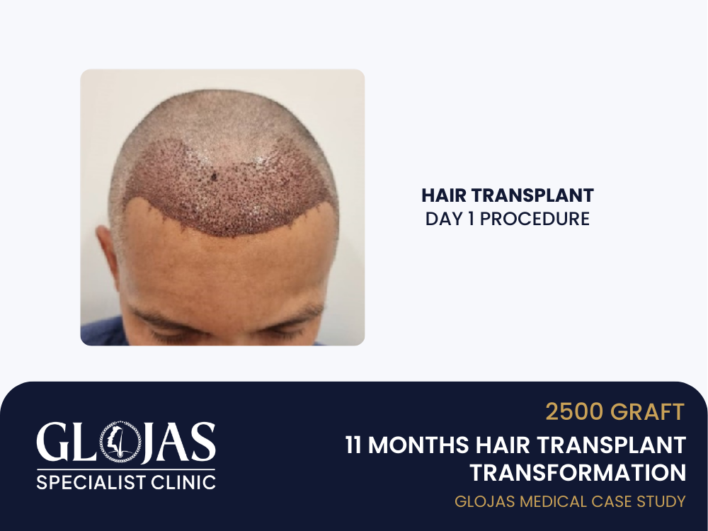 hair-transplant-day-1