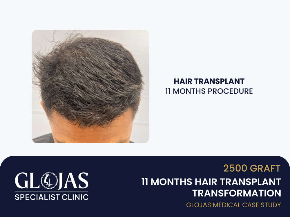 hair-transplant-11-months